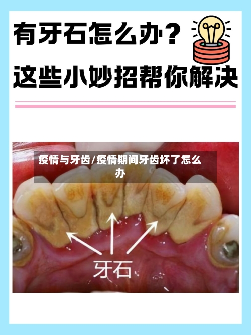 疫情与牙齿/疫情期间牙齿坏了怎么办-第2张图片