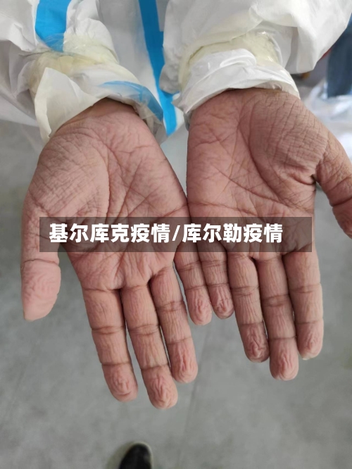基尔库克疫情/库尔勒疫情