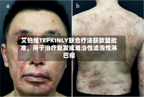 艾伯维TEPKINLY联合疗法获欧盟批准	，用于治疗复发或难治性滤泡性淋巴瘤-第3张图片