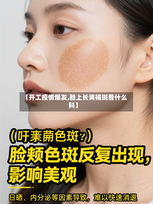 【开工疫情爆发,脸上长黄褐斑看什么科】
