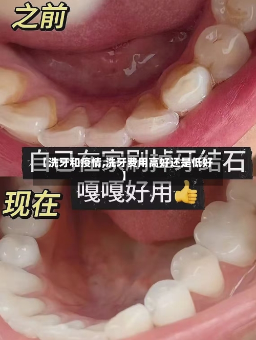 【洗牙和疫情,洗牙费用高好还是低好】