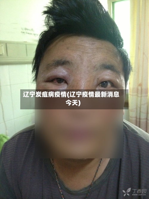 辽宁炭疽病疫情(辽宁疫情最新消息今天)